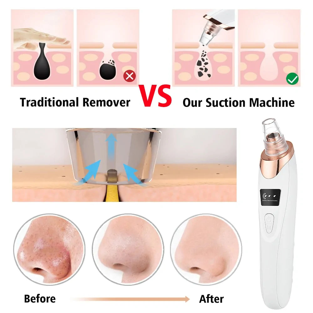 Rechargeable Facial Skin Care Vacuum for Acne & Oil Control